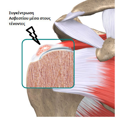 asbestopoios tenontitida sigkentrvsh asbestioy